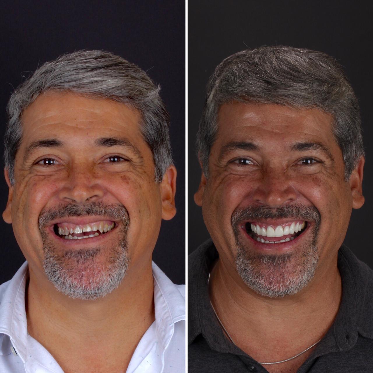 Lentes-de-Contato-Dental-com-o-objetivo-estetico..jpg