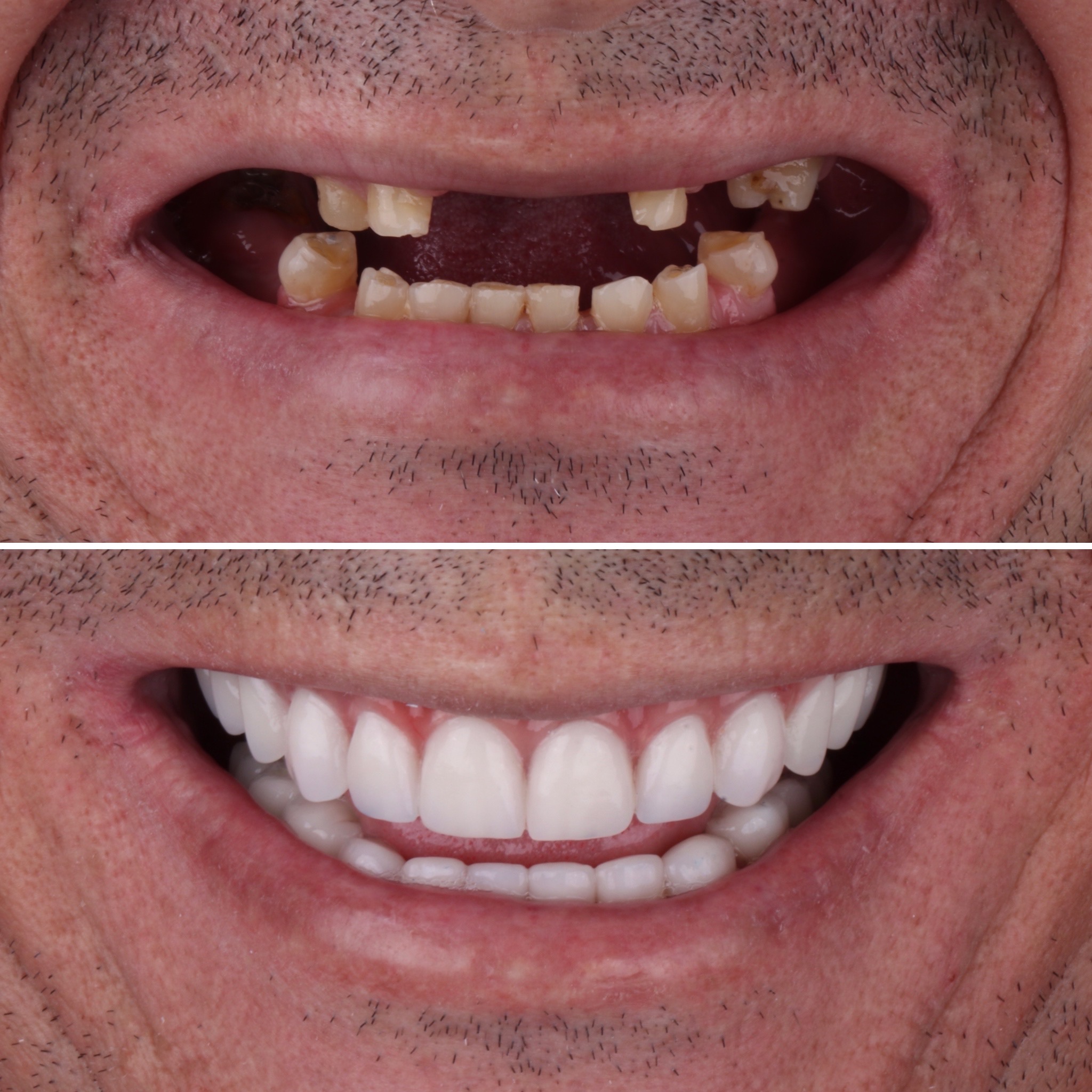 Reabilitacao-total-com-protocolo-sobre-implantes-e-laminados-ceramicos..jpg